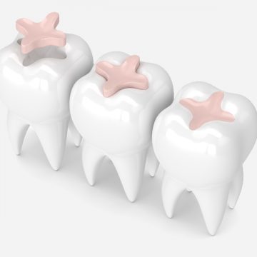 Important FAQs about Dental Fillings near You