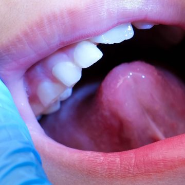 How Can Dental Sealants Help Adults Prevent Cavities?